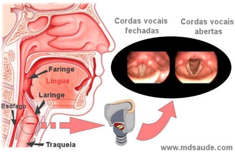 Cancer laringe faringe sintomas, Cancerul de laringe