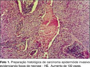 Cancer laringe histologia   Cancerul Sferei ORL