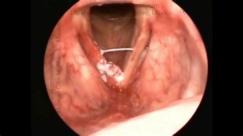 Cancer laringe y cuerdas vocales   Papilom intraductal cancer