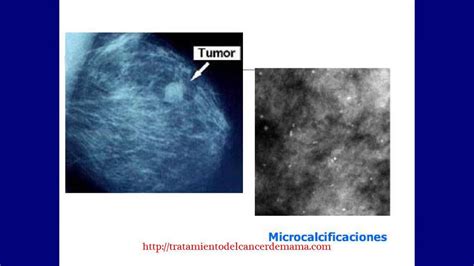 Cancer mamas sintomas  tratamiento del cancer de mama ...