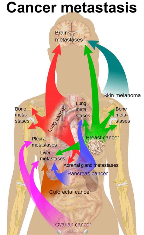 Cancer metastasis causes, symptoms and metastasis survival ...