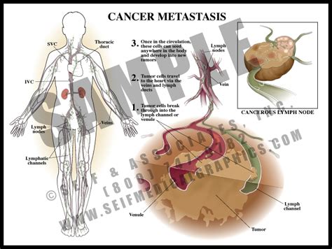 Cancer Metastasis   S&A Medical Graphics