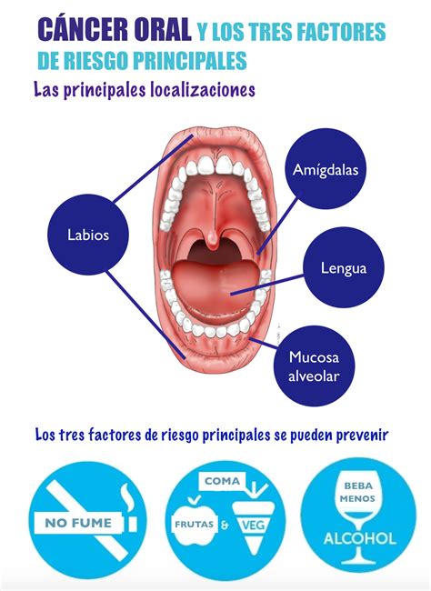 Cáncer Oral | Campaña Precoz Cáncer Oral