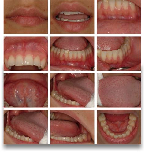 Cáncer Oral | Campaña Precoz Cáncer Oral