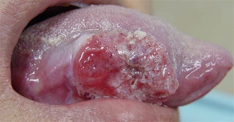 cáncer oral: Cáncer Oral
