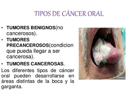 Cancer oral
