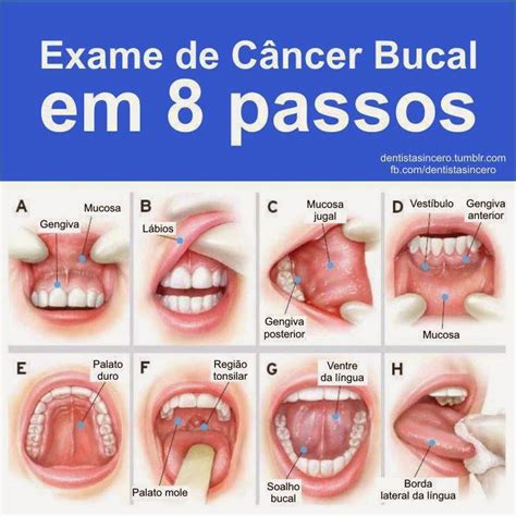 CANCER ORAL O BUCAL: CANCER ORAL O BUCAL