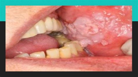 Cancer oral oliver1