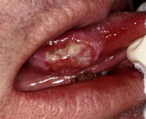 Cáncer oral – El blog de odontología