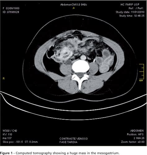 Cancer peritoneal fase 4. Impotenta cancer ginecologic și ...