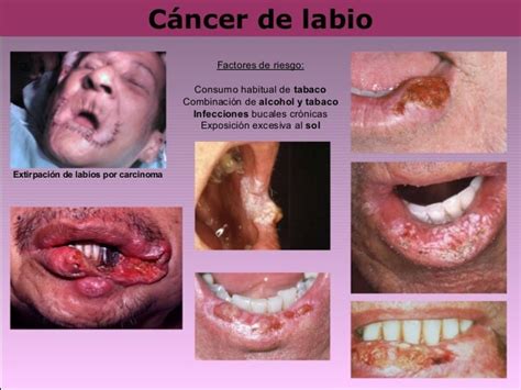 cancer por fumar: Tipos De Cancer Al Fumar