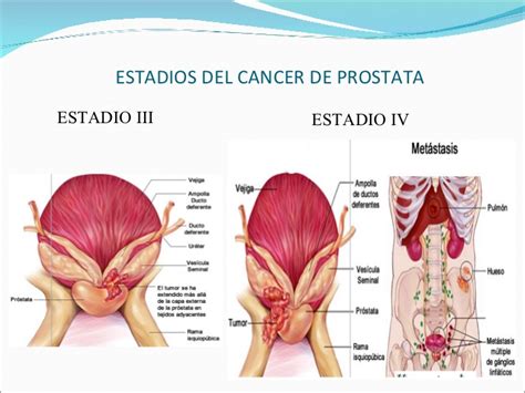 Cancer Prostata