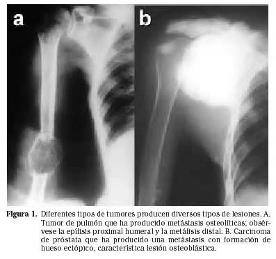 Cancer Pulmon Metastasis Huesos SEONegativo.com