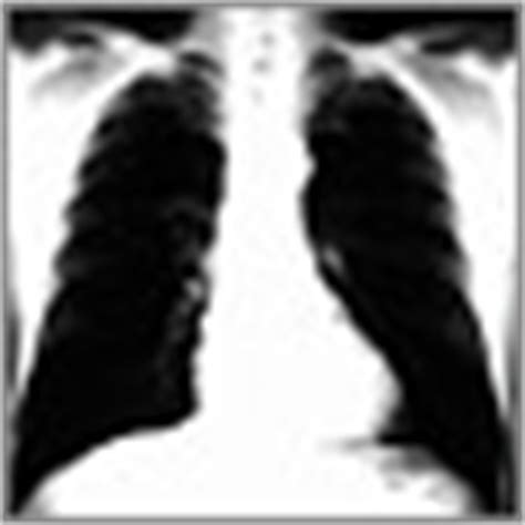 Cáncer pulmonar de células pequeñas: MedlinePlus ...