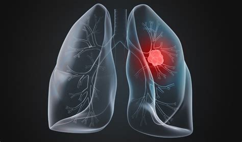 Cáncer Pulmonar | Dr. Víctor Gómez Ponce