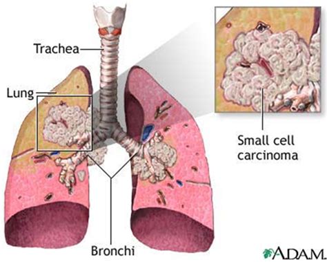 Cancer: Small Cell Carcinoma