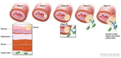 Cancer Stages