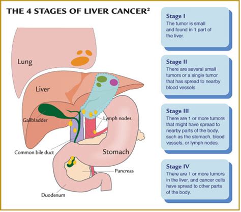 Cancer Symptoms: Cancer Final Stages Symptoms