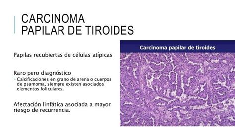 Cancer tiroides