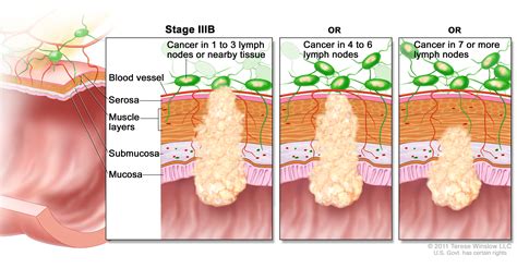 CancerTypes Colon Cancer Treatment  PDQ