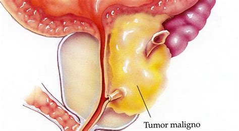 Cancro alla prostata: aggiunta di abiraterone al ...