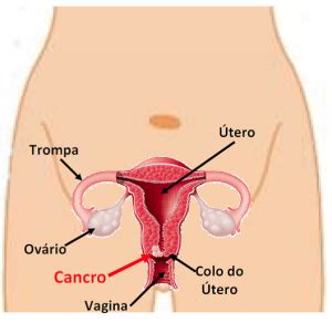 Cancro do Colo do Útero, Câncer Cervical, ou Câncer do ...