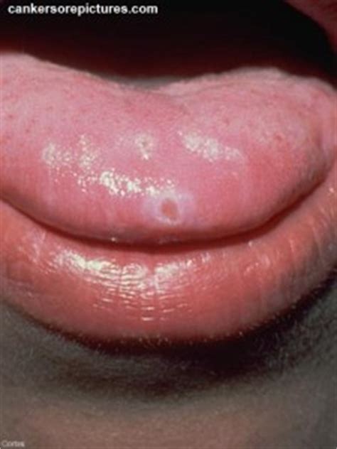 Canker Sore in Mouth  Tongue, Lips and Gums    Pictures ...