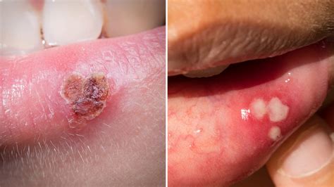 Canker Sore vs. Cold Sore: What s the Difference?   Health