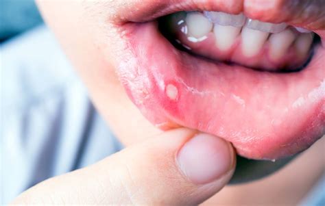 Canker Sores  Aphthous Stomatitis Or Recurrent Mouth ...