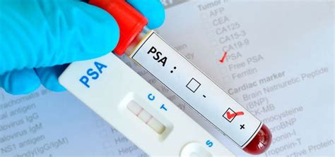 Cápsulas de Salud: ¿Qué es una prueba de PSA  antígeno ...