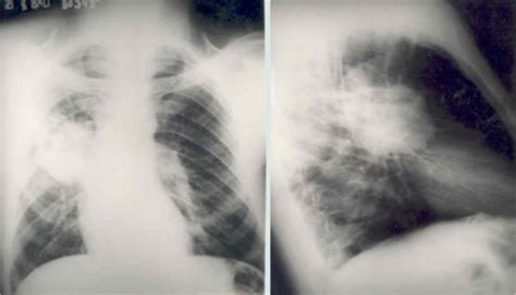 Carcinoma abscedado del pulmón: estudio prospectivo