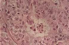 Carcinoma apocrino de mama: análisis inmunohistoquímico de dos casos ...