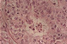 Carcinoma apocrino de mama: análisis inmunohistoquímico de ...