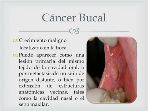 Carcinoma bucal