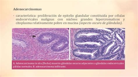 Carcinoma cervico uterino