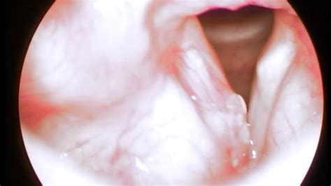 Carcinoma cuerda vocal derecha.wmv   YouTube