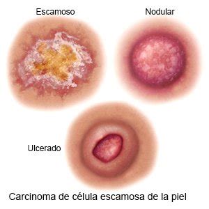 Carcinoma De Células Escamosas Care Guide Information En ...