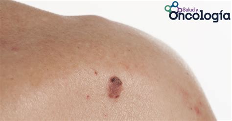 Carcinoma de células escamosas de la piel, afección ...