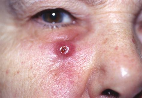 Carcinoma de células escamosas de la piel: causas ...