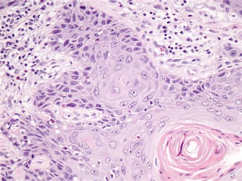 Carcinoma de células escamosas de la vulva | Nidos ...