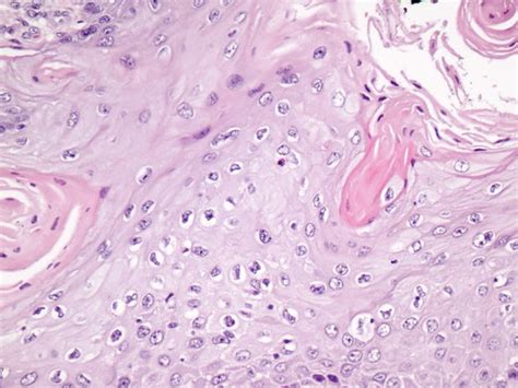 Carcinoma de células escamosas de la vulva | Nidos ...