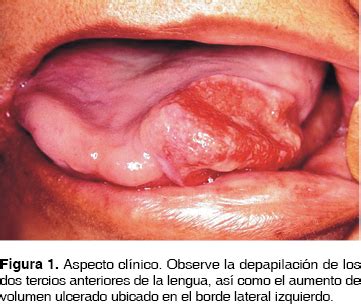 Carcinoma de células escamosas en lengua en un paciente ...