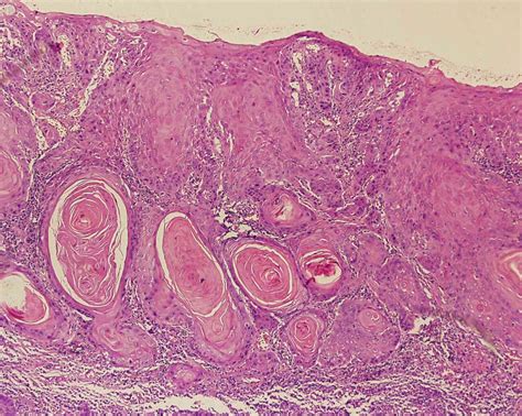 Carcinoma de Células Escamosas | Estomatologia Online