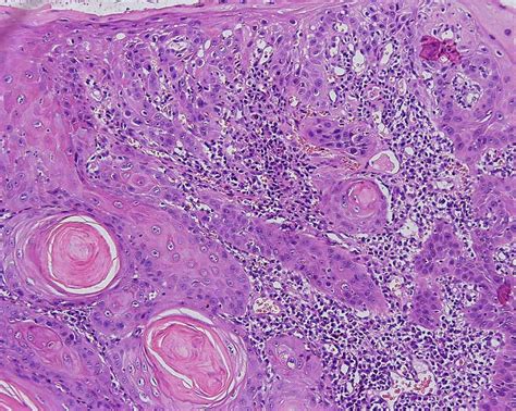Carcinoma de Células Escamosas | Estomatologia Online