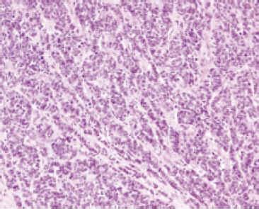 Carcinoma de células pequeñas primario de vejiga tratado ...