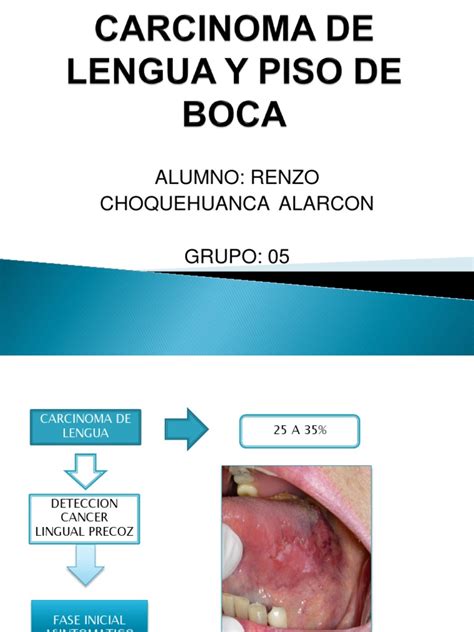 Carcinoma de Lengua y Piso de Boca | Cáncer | Epidemiología