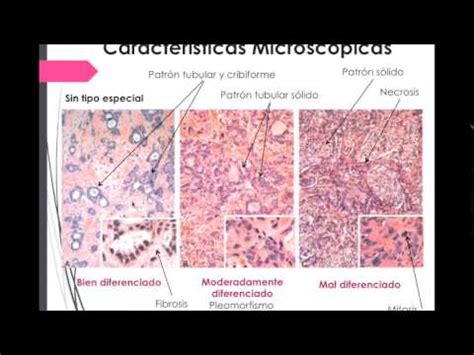 Carcinoma de mama: descripción patológica   YouTube