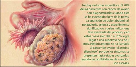 Carcinoma De Ovario   SEONegativo.com
