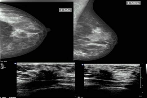 Carcinoma en tejido mamario ectópico axilar con diferenciación ...