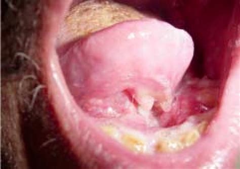Carcinoma epidermóide em região de soalho bucal ...